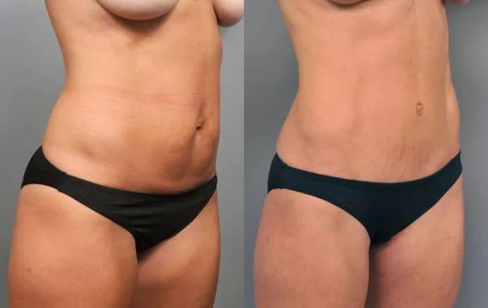 Avant / après Contour Paris